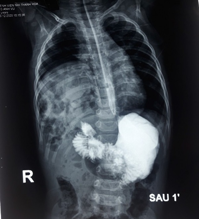 Bé trai 10 tháng tuổi có gan và quai ruột chui lên lồng ngực - 1 Bé trai 10 tháng tuổi có gan và quai ruột chui lên lồng ngực - 1