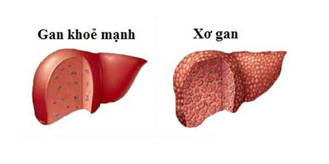 Đau tức hạ sườn, chân tay tê ngứa: Triệu chứng cảnh báo xơ gan - 1 Đau tức hạ sườn, chân tay tê ngứa: Triệu chứng cảnh báo xơ gan - 1