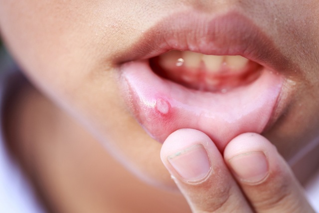 8 dấu hiệu phát hiện sớm ung thư khoang miệng - 2