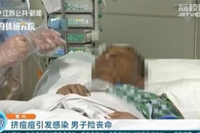 Suýt chết vì không nghe vợ, quyết nặn mụn ở cằm - 1 Suýt chết vì không nghe vợ, quyết nặn mụn ở cằm - 1