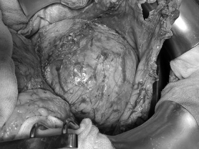 Tăng hơn 10kg, nữ bệnh nhân tá hỏa phát hiện khối u tụy khổng lồ - 1