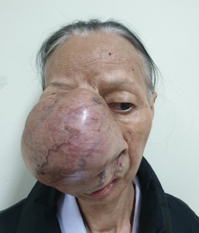 Khối u khổng lồ ăn sâu vào xương vùng mặt người phụ nữ nghèo - 1 Khối u khổng lồ ăn sâu vào xương vùng mặt người phụ nữ nghèo - 1