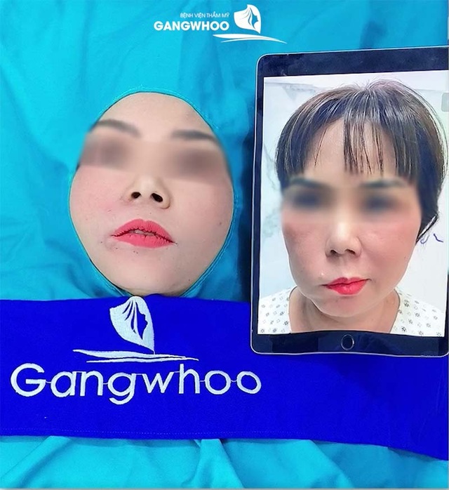 Bệnh viện thẩm mỹ Gangwhoo: Thông điệp xúc động đằng sau câu chuyện giải cứu dây thần kinh số 7 - 3 Bệnh viện thẩm mỹ Gangwhoo: Thông điệp xúc động đằng sau câu chuyện giải cứu dây thần kinh số 7 - 3