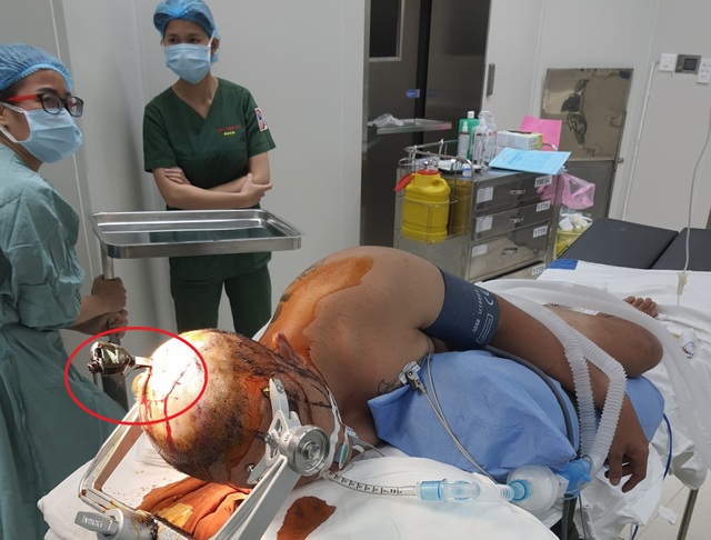 Nam thanh niên nhập viện với chùm chìa khóa cắm trên đỉnh đầu - 2 Nam thanh niên nhập viện với chùm chìa khóa cắm trên đỉnh đầu - 2