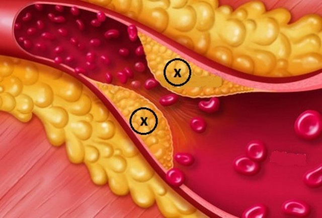 Xây dựng bộ tiêu chí chẩn đoán rối loạn lipid máu theo y học cổ truyền - 1 Xây dựng bộ tiêu chí chẩn đoán rối loạn lipid máu theo y học cổ truyền - 1
