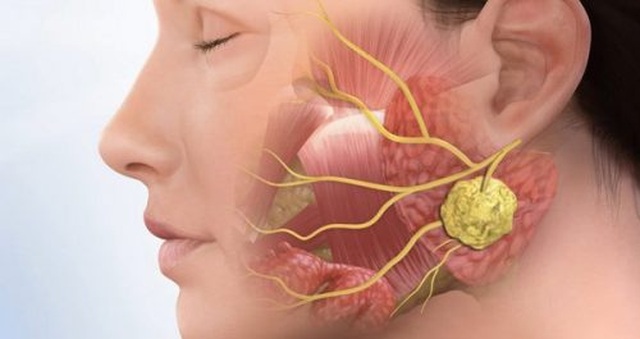 Phân biệt ung thư vòm họng với bệnh lý vùng mũi họng - 1