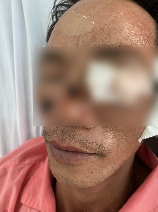 Thêm nhiều nạn nhân bị nổ mắt, cụt tay vì chơi pháo ngày Tết - 1 Thêm nhiều nạn nhân bị nổ mắt, cụt tay vì chơi pháo ngày Tết - 1