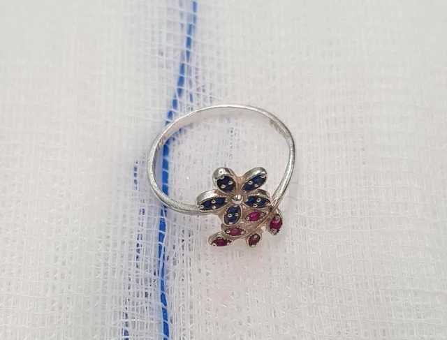 Nuốt chiếc nhẫn được tặng trong ngày Valentine bé gái phải cấp cứu - 3 Nuốt chiếc nhẫn được tặng trong ngày Valentine bé gái phải cấp cứu - 3