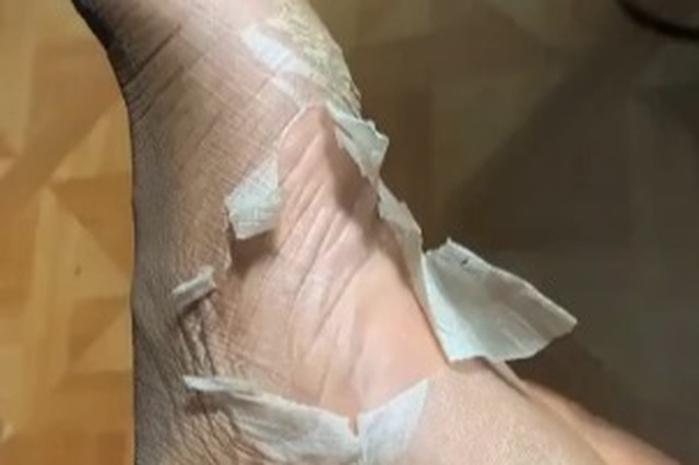 Kinh hãi với trào lưu lột da chân trên Tik Tok - 2 Kinh hãi với trào lưu lột da chân trên Tik Tok - 2