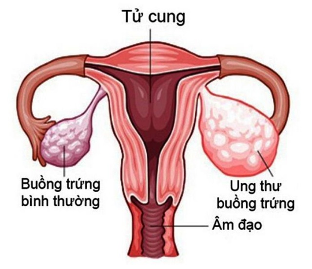 10 dấu hiệu khiến bạn nghĩ đến ung thư buồng trứng - 1