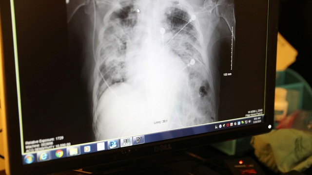 Mỹ: Bệnh nhân tử vong sau khi được ghép phổi từ người mắc Covid-19 - 1
