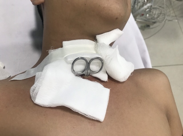 Tự gây thương tích, bệnh nhân nhập viện với cây kéo đâm xuyên cổ - 1 Tự gây thương tích, bệnh nhân nhập viện với cây kéo đâm xuyên cổ - 1
