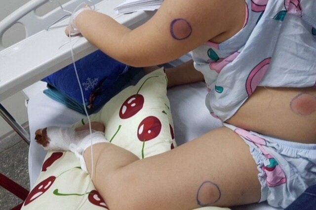 Cháu bé 6 tuổi nhiễm vi khuẩn ăn thịt người sau khi bị gà mổ vào chân - 1