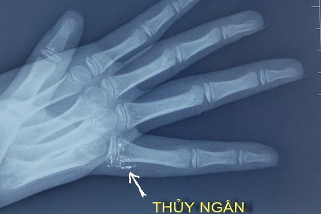 Hy hữu: Bé gái nhập viện với các hạt thủy ngân lổn nhổn sâu trong da tay - 1 Hy hữu: Bé gái nhập viện với các hạt thủy ngân lổn nhổn sâu trong da tay - 1