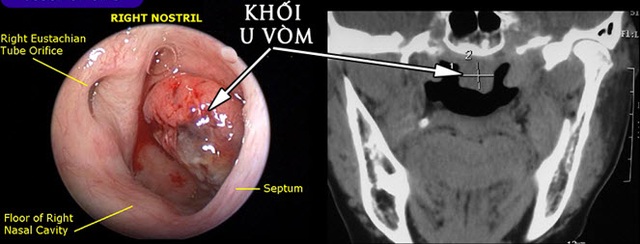 Ù tai kéo dài coi chừng ung thư vòm họng | Báo Dân trí