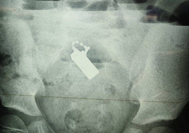 Nuốt nam châm, bé trai 6 tuổi bị thủng ruột - 1 Nuốt nam châm, bé trai 6 tuổi bị thủng ruột - 1
