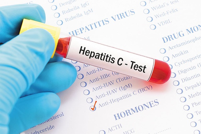 Mệt mỏi, vàng da: Có thể gan đang bị tấn công bởi loại virus nguy hiểm - 1 Mệt mỏi, vàng da: Có thể gan đang bị tấn công bởi loại virus nguy hiểm - 1