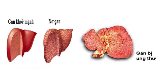 Dấu hiệu trên da cảnh báo bệnh ung thư chết người - 2