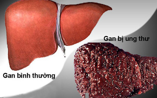 Cô gái 32 tuổi sốc khi phát hiện ung thư gan sau khi có biểu hiện mẩn ngứa, khô mắt - 1 Cô gái 32 tuổi sốc khi phát hiện ung thư gan sau khi có biểu hiện mẩn ngứa, khô mắt - 1