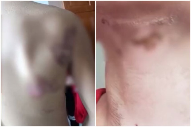 Vận động viên trẻ Trung Quốc bị ngược đãi, tạt nước sôi vào người - 1 Vận động viên trẻ Trung Quốc bị ngược đãi, tạt nước sôi vào người - 1