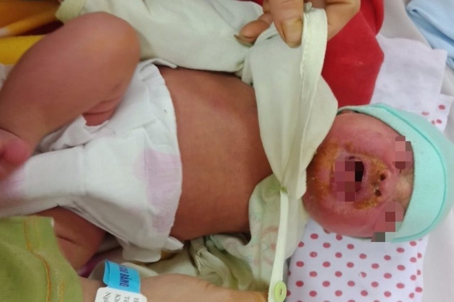 Tắm bằng nước lá, bé 20 ngày tuổi phải nhập viện vì nhiễm độc - 1