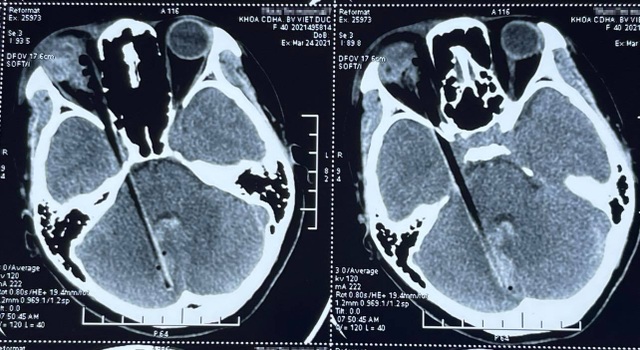 Hy hữu: Cứu sống bệnh nhân bị mảnh gỗ đâm xuyên mắt, sọ não