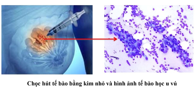 Sinh thiết vú là gì? - 1 Sinh thiết vú là gì? - 1