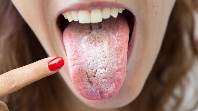 Lưỡi xuất hiện triệu chứng này coi chừng ung thư gan - 1