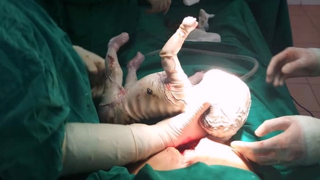 Cô gái 15 tuổi sinh con toàn thân bọc vảy trắng, da nứt nẻ, chảy máu - 1 Cô gái 15 tuổi sinh con toàn thân bọc vảy trắng, da nứt nẻ, chảy máu - 1