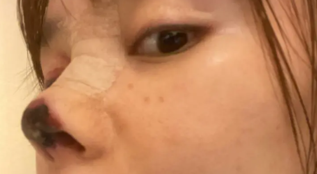 Người đẹp Trung Quốc mũi hoại tử đen sì sau phẫu thuật thẩm mỹ hỏng - 1 Người đẹp Trung Quốc mũi hoại tử đen sì sau phẫu thuật thẩm mỹ hỏng - 1