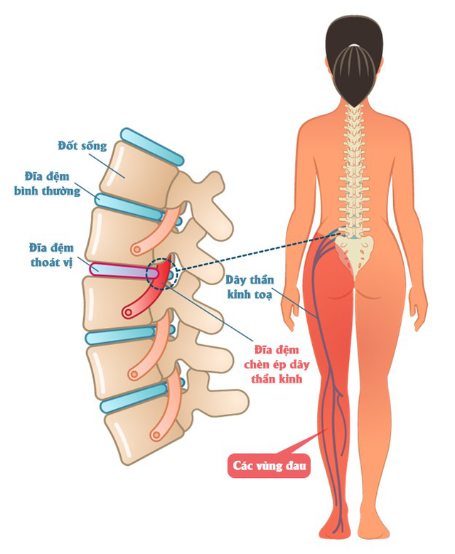 Phương pháp Chiropractic điều trị đau cơ xương khớp - 3 Phương pháp Chiropractic điều trị đau cơ xương khớp - 3