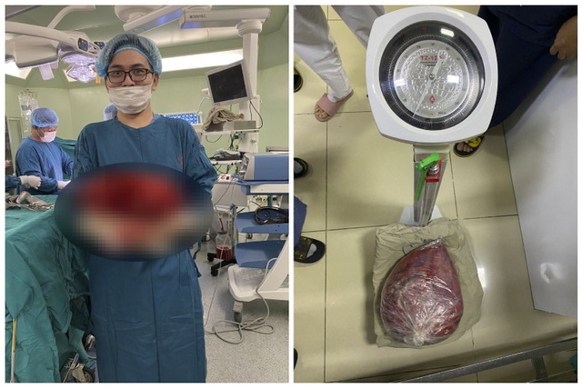 Sốc: Khối u 10kg trong bụng nữ bệnh nhân - 1 Sốc: Khối u 10kg trong bụng nữ bệnh nhân - 1