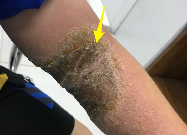Bó thuốc trị gãy xương, cánh tay cậu bé bị nhiễm trùng nặng - 1 Bó thuốc trị gãy xương, cánh tay cậu bé bị nhiễm trùng nặng - 1