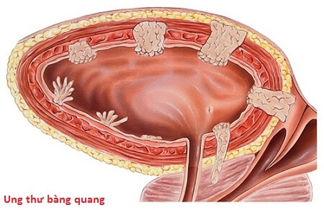 Điểm mặt các yếu tố nguy cơ gây ung thư bàng quang - 1 Điểm mặt các yếu tố nguy cơ gây ung thư bàng quang - 1