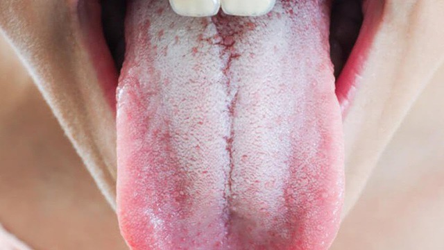 Nhìn vào miệng để bắt bệnh lá gan - 3