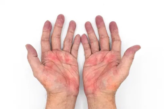 Mệt mỏi, da mẩn đỏ: Có thể virus đang tàn phá lá gan - 5 Mệt mỏi, da mẩn đỏ: Có thể virus đang tàn phá lá gan - 5