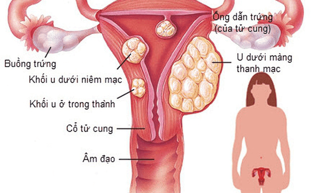 U xơ tử cung và những nguy cơ khó lường chị em cần biết - 2 U xơ tử cung và những nguy cơ khó lường chị em cần biết - 2