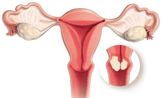 Có những đặc điểm này chị em cần cảnh giác với ung thư tử cung - 1 Có những đặc điểm này chị em cần cảnh giác với ung thư tử cung - 1