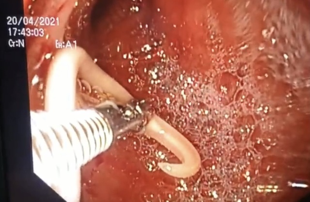 Bị giun đũa chui vào ống tụy, bé trai quằn quại đau đớn - 1 Bị giun đũa chui vào ống tụy, bé trai quằn quại đau đớn - 1