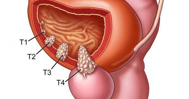 Dấu hiệu ung thư bàng quang giai đoạn đầu và khi đã di căn - 1