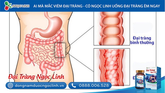 Xua tan nỗi lo viêm đại tràng - 1 Xua tan nỗi lo viêm đại tràng - 1