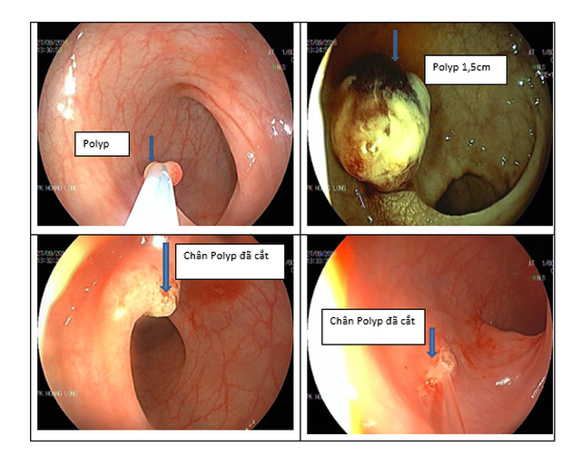 Có nên cắt polyp đại tràng để ngừa ung thư? - 1