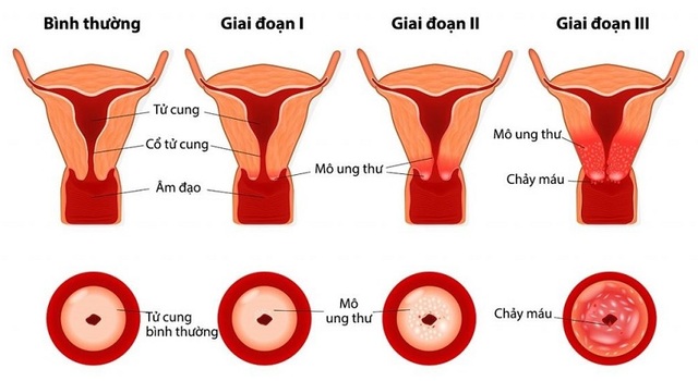 Ung thư cổ tử cung, những điều mọi phụ nữ nên biết về căn bệnh này - 1 Ung thư cổ tử cung, những điều mọi phụ nữ nên biết về căn bệnh này - 1