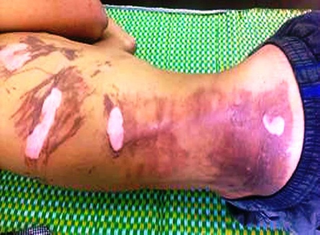 Bỏng toàn thân vì ngậm xăng phun lửa lúc múa lân - 1 Vết bỏng trên người bệnh nhân N. (Ảnh: CTV)