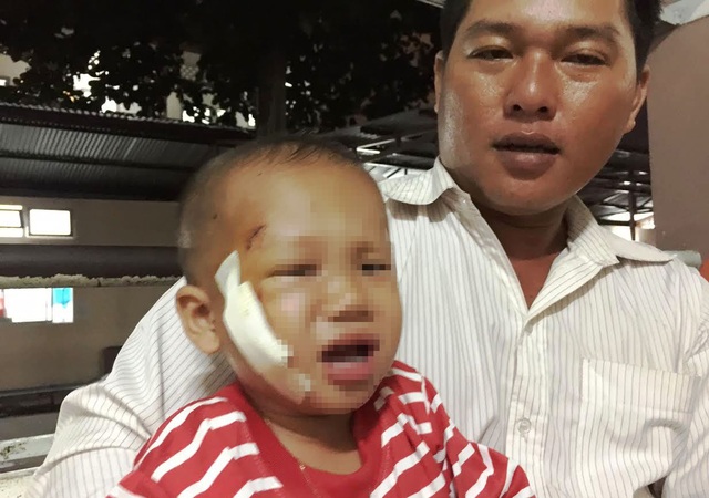 Bé Lâm bị cây đâm xuyên mặt sau khi té cầu khỉ và hiện đang được điều trị tại BV Nhi đồng 2, T HCM.