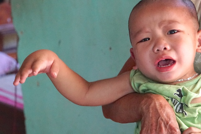 Xót xa nhìn bé 3 tuổi mang nỗi đau phì đại chân tay - 8 Căn bệnh tay to đối nghịch với chân khiến cháu thường xuyên đau đớn.