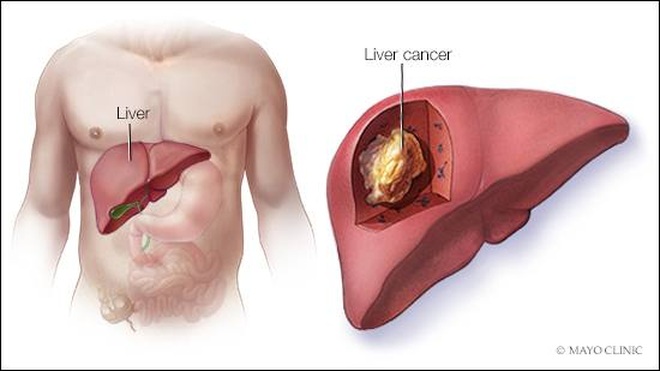 Mối liên hệ giữa viêm gan B và ung thư gan - 1