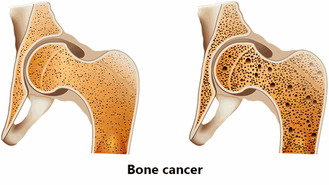 Dấu hiệu ung thư di căn đến xương - 1