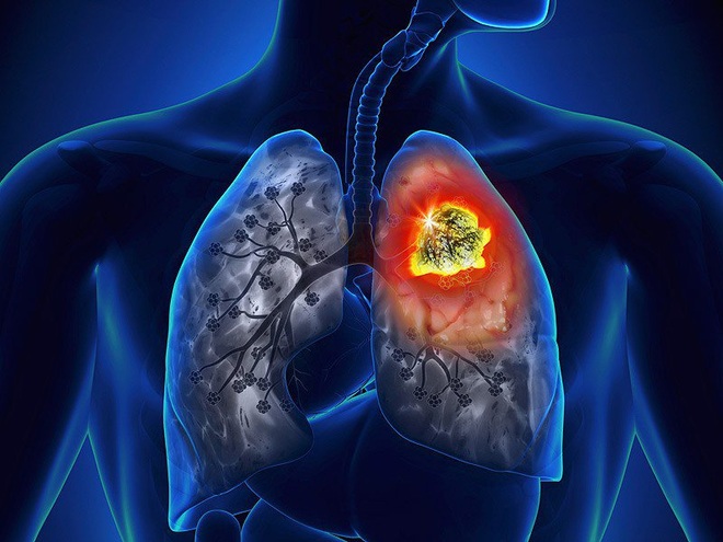 Đau vai- dấu hiệu ung thư phổi - 1