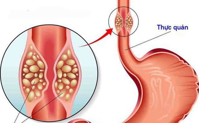 Triệu chứng phổ biến nhất của ung thư thực quản - 1 Triệu chứng phổ biến nhất của ung thư thực quản - 1